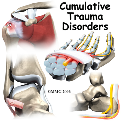 Cumulative Trauma Disorder