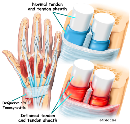 general_tendonitis_dq_anatomy06 Biology Diagrams